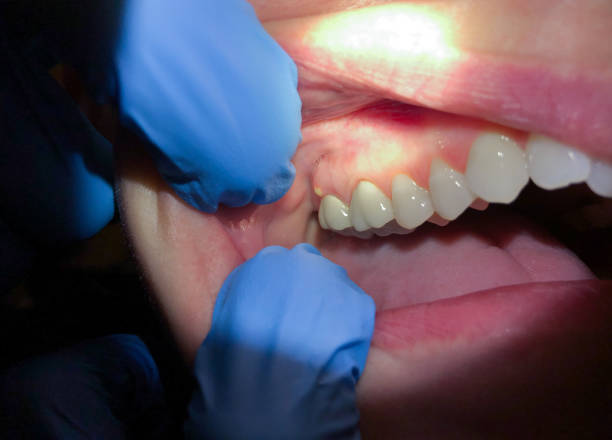 Best Urgent Care for Lost Fillings or Crowns in Roosevelt, NJ